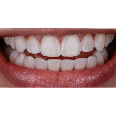 Invisalign After